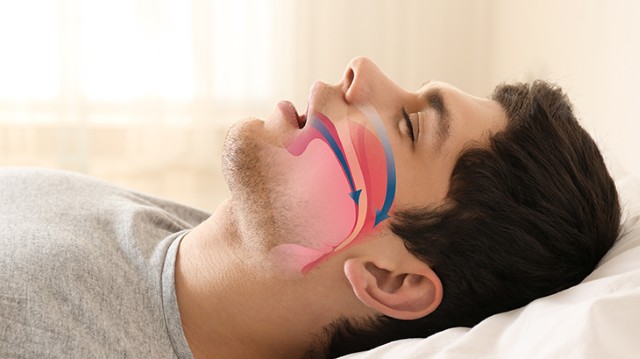 Bu Belirtileri Yaşıyorsanız Uyku Apnesi Olabilirsiniz1