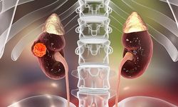 Böbrek Kanseri Sinsice İlerliyor!