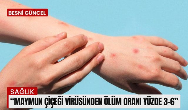 Maymun çiçeği virüsünden korunma yolları