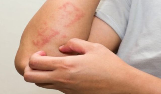 Mevsim Geçişleri Alerjik Sorunları Tetikliyor