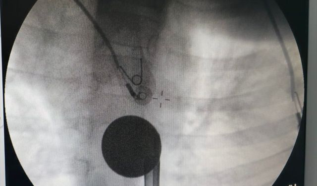 Siirt'te çocuğun boğazına kaçan madeni para çıkarıldı