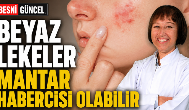 Yazın Ciltteki Beyaz Lekelere Dikkat!