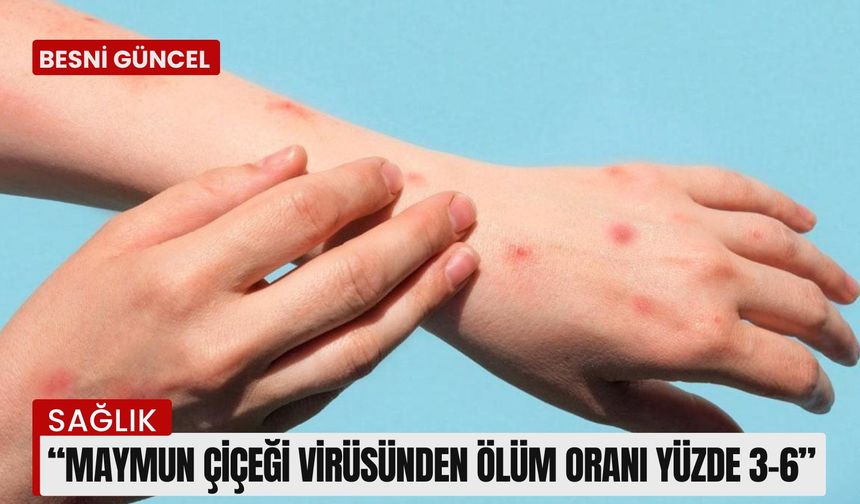 Maymun çiçeği virüsünden korunma yolları