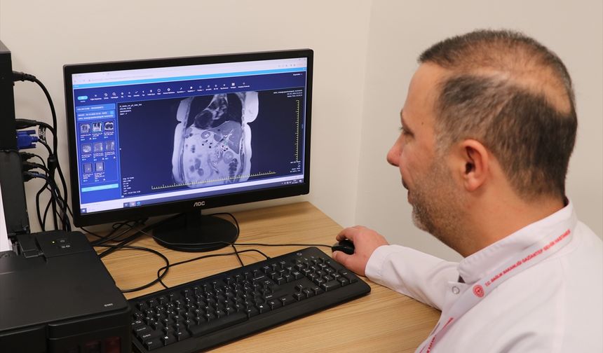 Ters Organlı Hastanın Safra Taşı ERCP ile Alındı